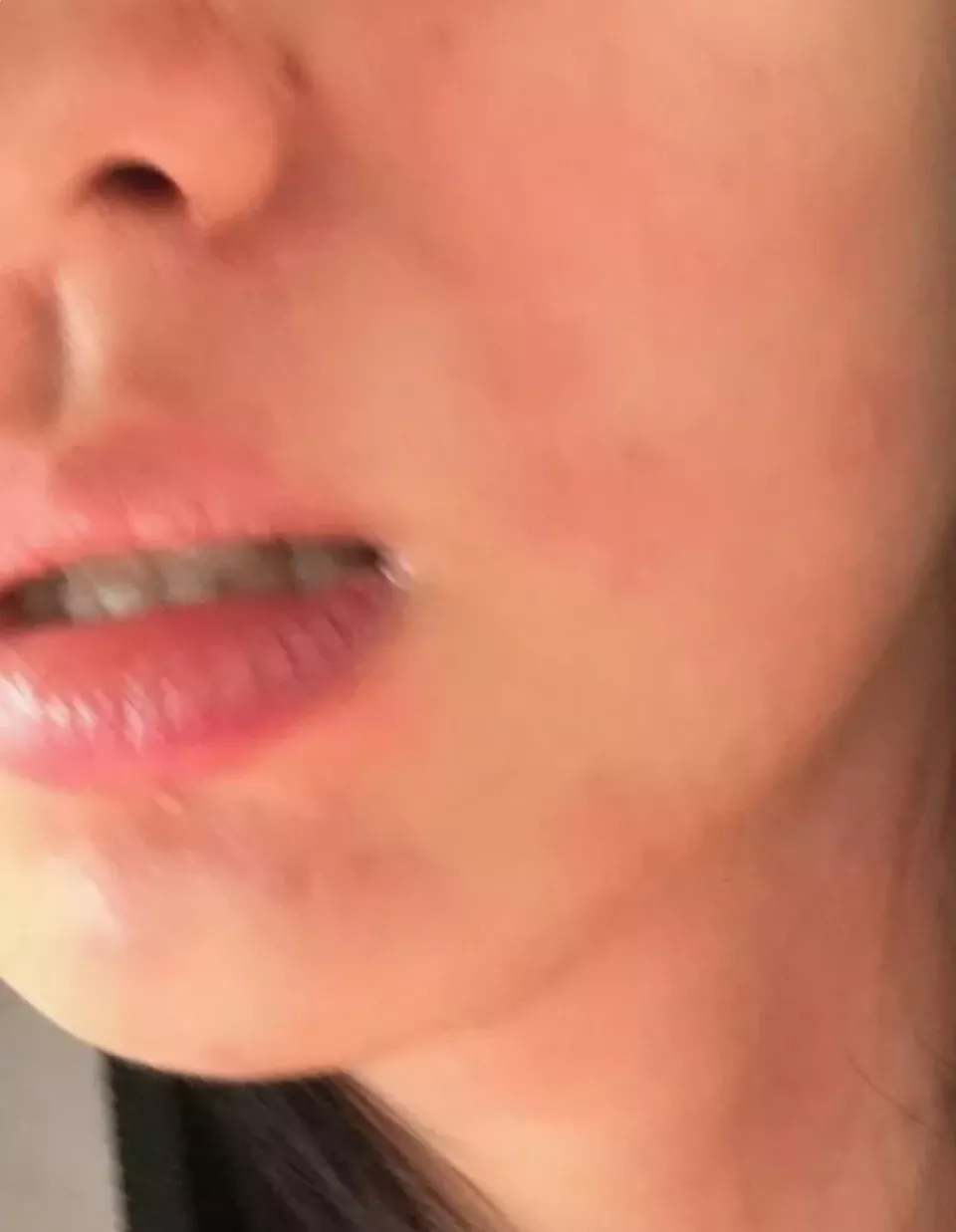 女演员王楚然求治荨麻疹,网友大呼感同身受:太折磨人