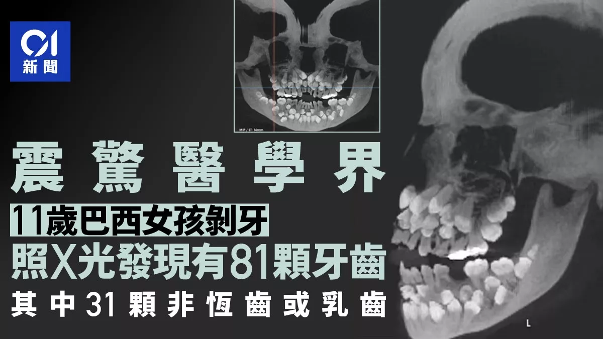 女童想拔牙 照X光惊见81颗牙 31颗非恆齿或乳齿(慎入)