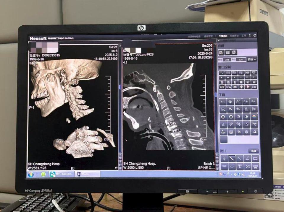 “身首离断”被救回引关注！主刀医生讲述从医30多年最凶险情况