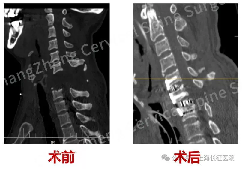 全球罕见!“身首离断”患者被救回