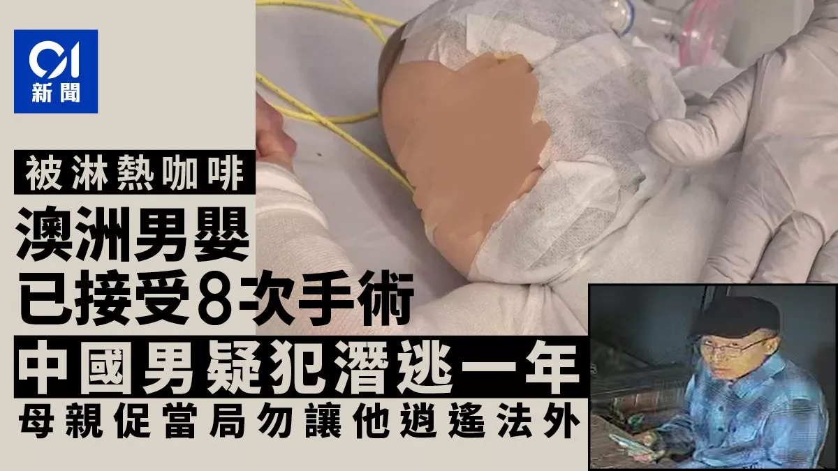 澳男婴被中国男严重烫伤1周年:已8次手术 母亲促…