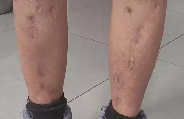 戴浩腿上术后留下的疤痕 （受访者提供）