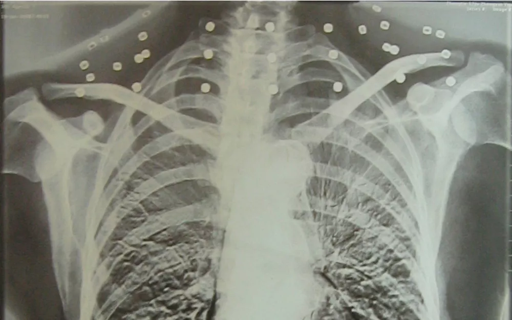 "老先生,您把项链取下来再做CT""你看是不是弹片"