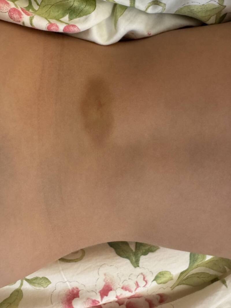 新竹市再传私立幼儿园老师对幼童施暴， 数名幼童遭闪耳光捏大腿转耳朵，身体也出现多处淤青。（读者提供）