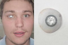 太狂!美独眼珠宝师砸6千万 将2克拉钻石镶入义眼