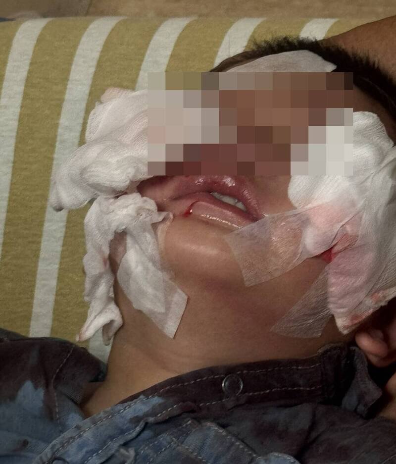 嘉义县义竹乡1岁多男童被犬只咬伤脸部。（民众提供）