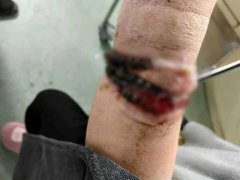 10年没拔!手镯「长进肉里」化脓飘恶臭 中国女险截肢